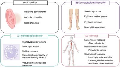 Vasculitis associated with VEXAS syndrome: A literature review